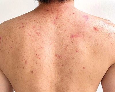 Mechanische Acne - Herkenning en behandeling