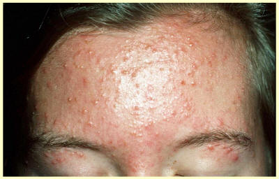 Comedonale Acne - Herkenning en behandeling