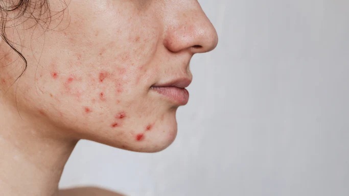 Hormonale Acne - Herkenning en behandeling