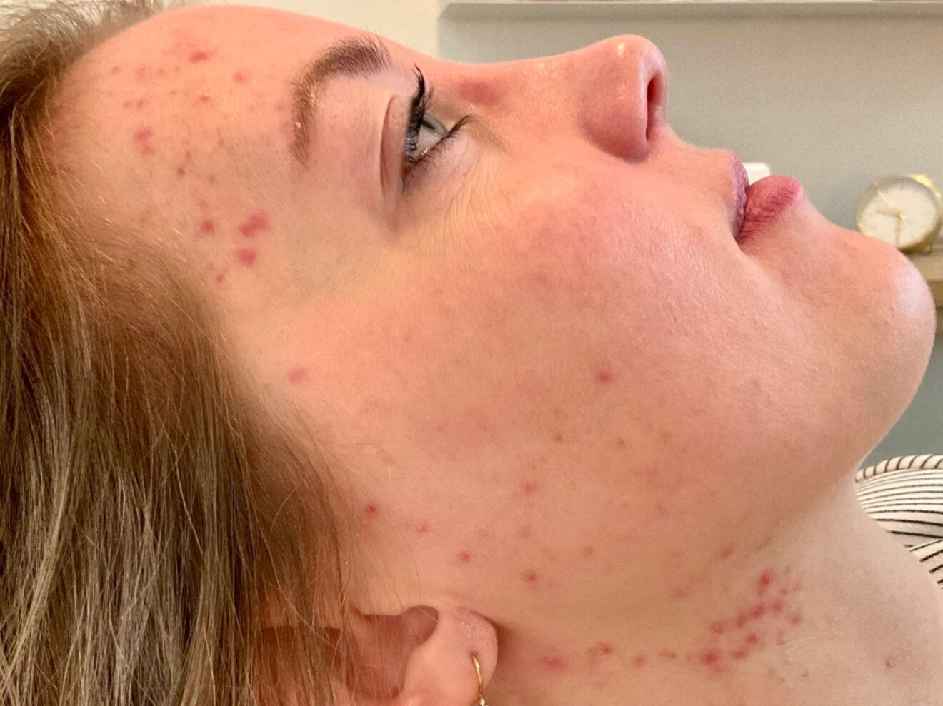 Inflammatoire Acne - Herkenning en behandeling