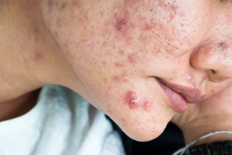 Nodulaire Acne - Herkenning en behandeling