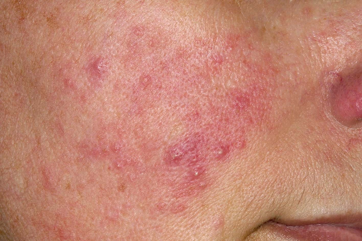 Acne Rosacea - Herkenning en behandeling